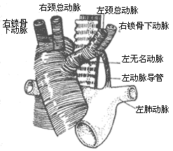 先天性主动脉弓畸形