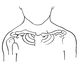 (图1)锁骨两端之间可扪及不同程度活动,无压痛,锁骨胸骨端偏上,位于另