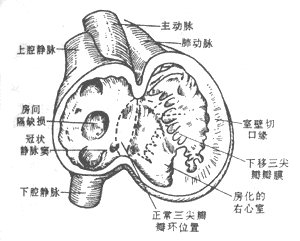 三尖瓣下移畸形