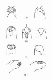 手指残端各种局部皮瓣设计 (1)指端三角皮瓣 (2)v-y皮瓣 (3)指背
