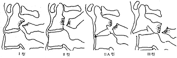 hangman骨折的levine-edwards分类; 伴齿状突骨折的寰枢椎前脱位