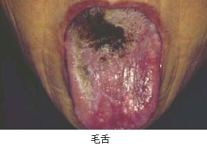 毛舌 毛舌(hairy tongue)是由于舌背上丝状乳头的角化上皮延缓脱落