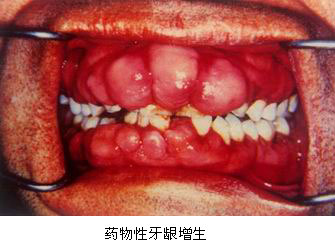 它只发生于有牙区,拔牙后,增生的牙龈组织可自行消退.