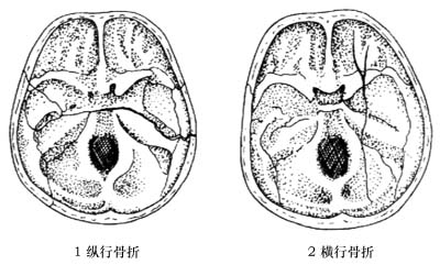 颞骨骨折