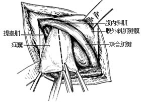 滑疝修复术