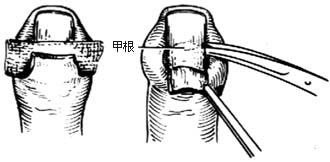 图2 甲沟炎伴甲下脓肿部分均甲引流术