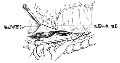 ⑷分离横结肠系膜前叶
