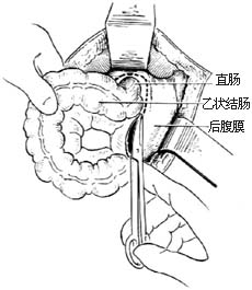 先天性直肠肛门畸形的手术