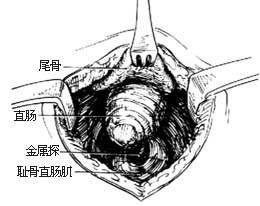 拉出直肠⑶缝扎,切断瘘管⑵分离直肠后间隙⑴切开直肠旁的后腹膜图4