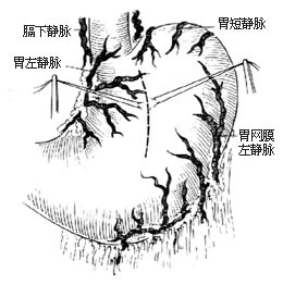 胃底静脉缝扎术