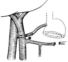 图5 选择性胃左静脉分流术