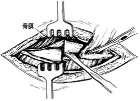 1-1 剥离骨膜,显露骨折端