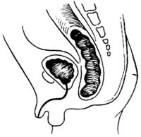 先天性直肠肛门畸形的手术