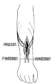 ⑶切口   ⑷向前臂背侧转移桡,尺侧屈腕肌腱,由切口  引出