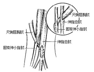 ⑺转移并缝合桡侧屈腕肌腱至外展拇长肌和伸拇长短肌腱上 ⑻转移尺侧