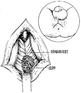 ⑴会阴部切口及纵行切开球海绵体肌