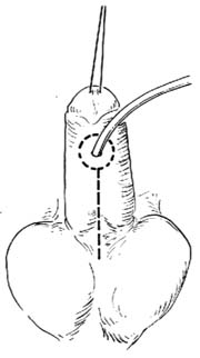 一期尿道下裂修复术