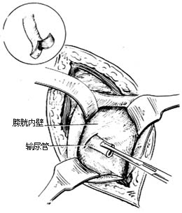 ⑴将输尿管拉入膀胱内