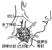 图21 舌下神经颈襻-带状肌蒂