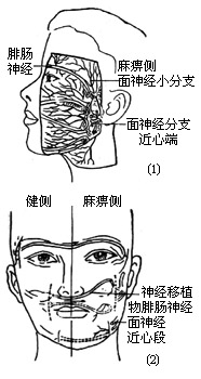 图24 健侧面神经缝合端 图25 麻痹侧面神经吻合端的面神经移植(1)侧位