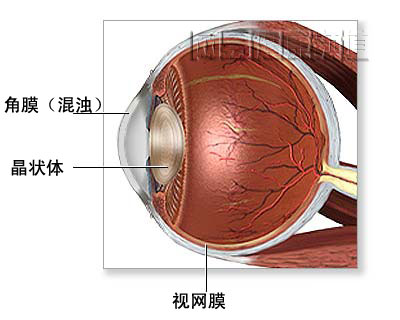 严重的角膜损伤,感染或瘢疤形成    2.