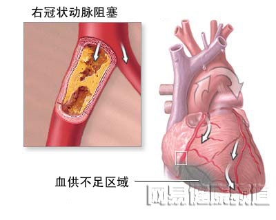 严重或血供非常不足时,就应当进行冠状动脉旁路移植术或心脏旁路手术